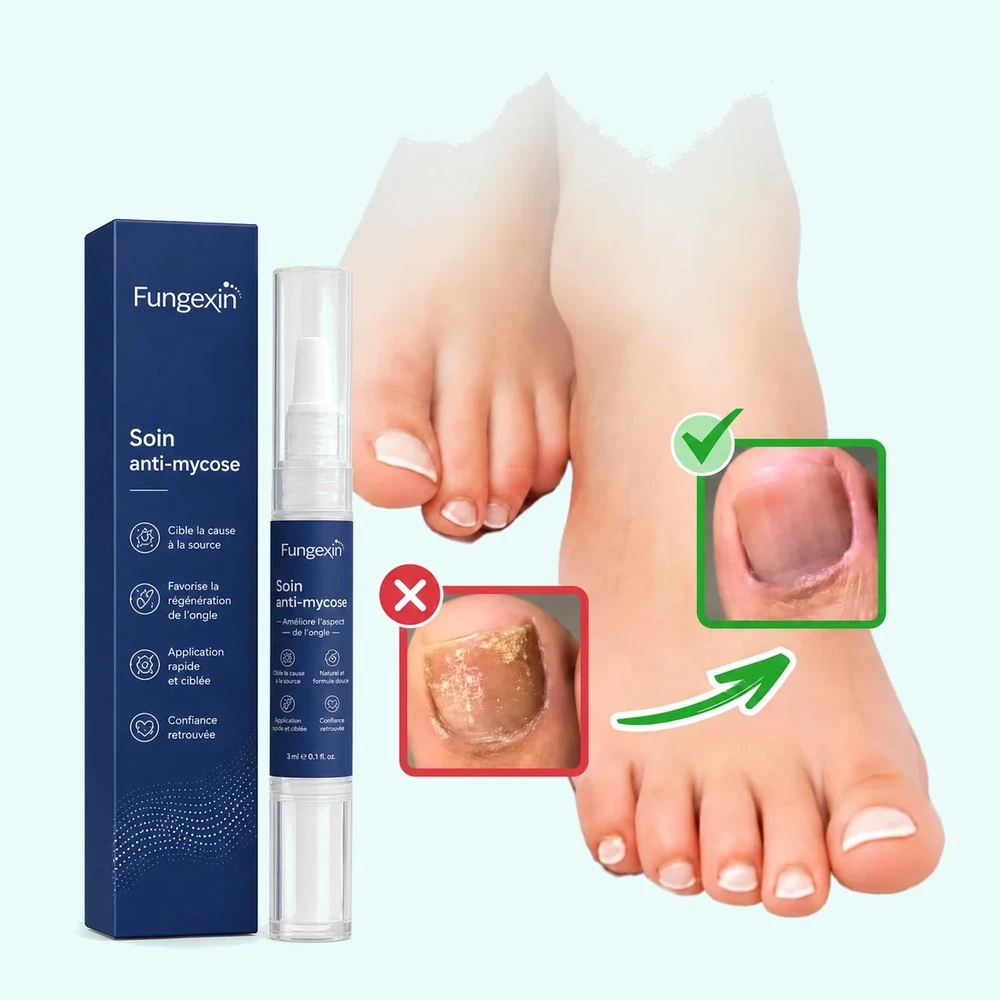 Stylo Fungexin et sa boite, ongle de pied avant et apres traitement