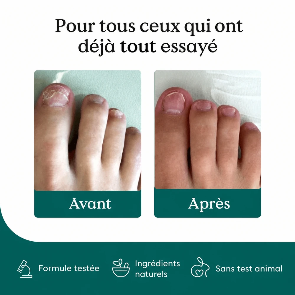 Pour tous ceux qui ont deja tout essaye : ongle avant et apres